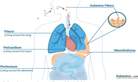 Mesothelioma Lawyers