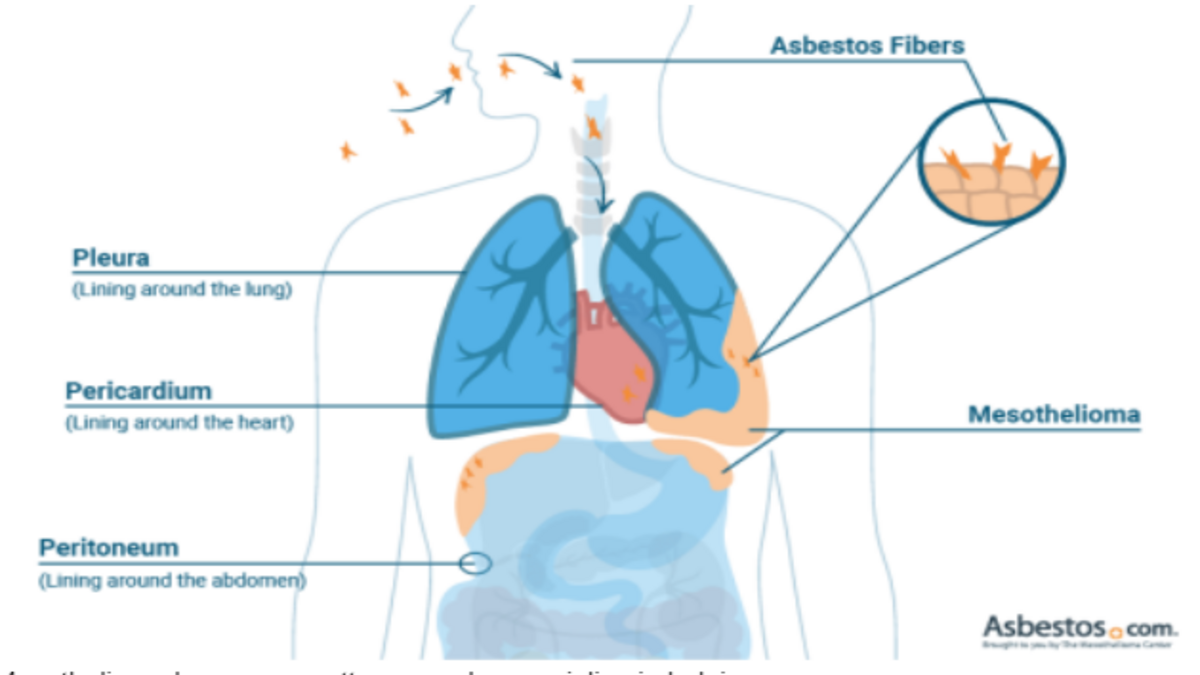 Mesothelioma Lawyers