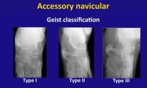 Accessory Navicular