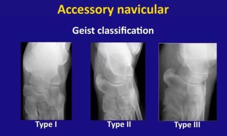 Accessory Navicular