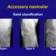 Accessory Navicular