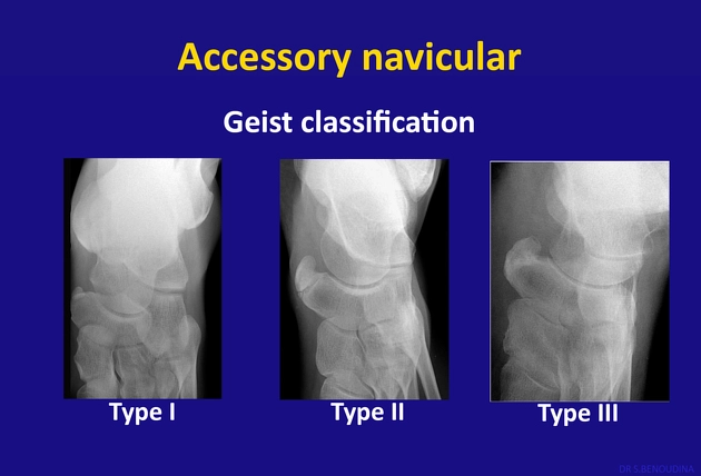 Accessory Navicular