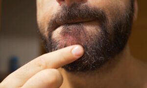 how to get rid of beard dandruff