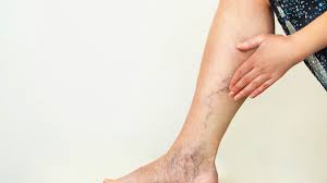 Varicose Veins Santa Fe