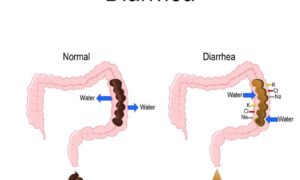DIARRHEA: SYMPTOMS, CAUSES, AND MEDICATION