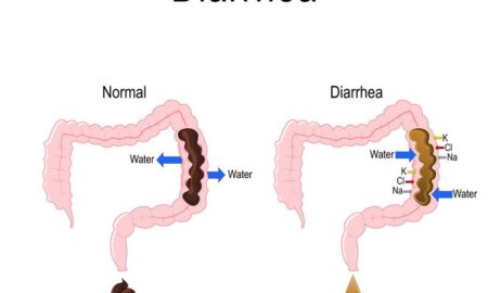 DIARRHEA: SYMPTOMS, CAUSES, AND MEDICATION