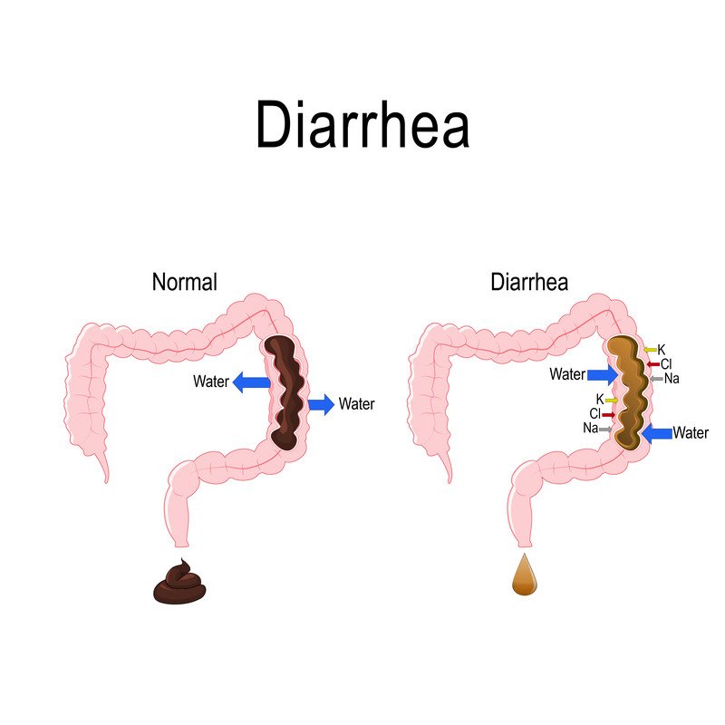 DIARRHEA: SYMPTOMS, CAUSES, AND MEDICATION