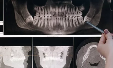 Gums Depigmented