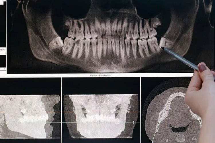 Gums Depigmented