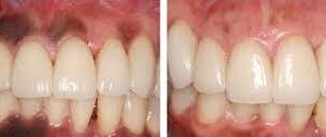 Gum depigmentation