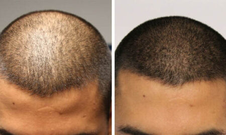 scalp