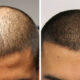 scalp