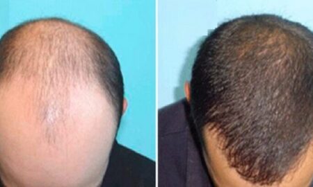 hair clinic turkey