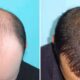hair clinic turkey