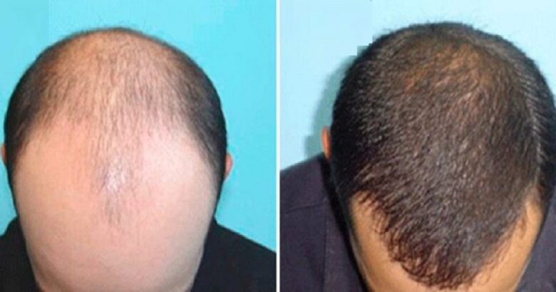 hair clinic turkey