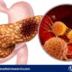 Exocrine Pancreatic Insufficiency Treatment Market