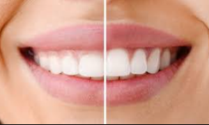 GUMS Procedure,,,