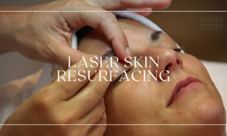 LASER SKIN RESURFACING