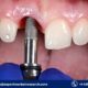 Aesthetic Implants Market