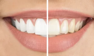 Teeth-Whitening-Naturally-Home-Remedies