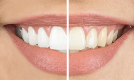 Teeth-Whitening-Naturally-Home-Remedies