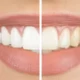 Teeth-Whitening-Naturally-Home-Remedies