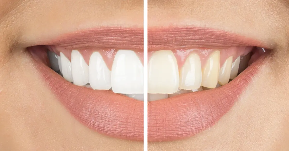 Teeth-Whitening-Naturally-Home-Remedies