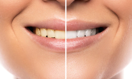 Teeth Whitening madison ms