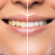 Teeth Whitening madison ms