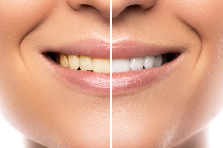 Teeth Whitening madison ms