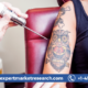 Tattoo Removal Market