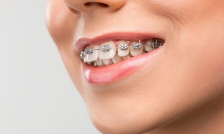 immediate dentures