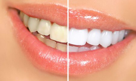teeth whitening products wholesale